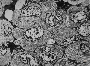 M,55y. | plasmocytoma M,55y. | plasmocytoma
